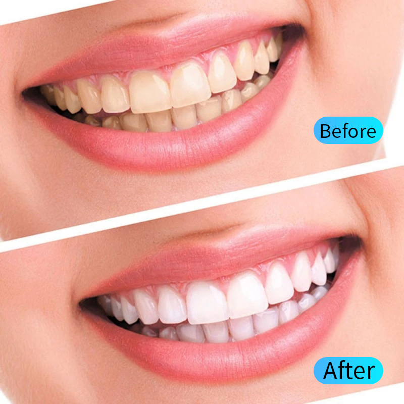 치아 미백 젤 키트 구강 위생 관리 치아 미백 도구 필 - Teeth Whitening Opalescence 리뷰 및 가격