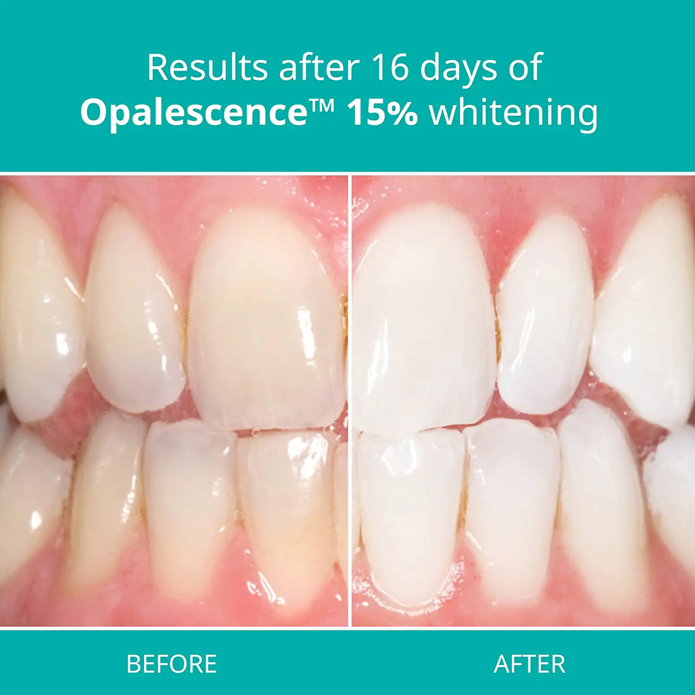 오팔레센스 프로페셔널 화이트닝 키트 15% 젤 PF 1 - Teeth Whitening Opalescence 리뷰 및 가격