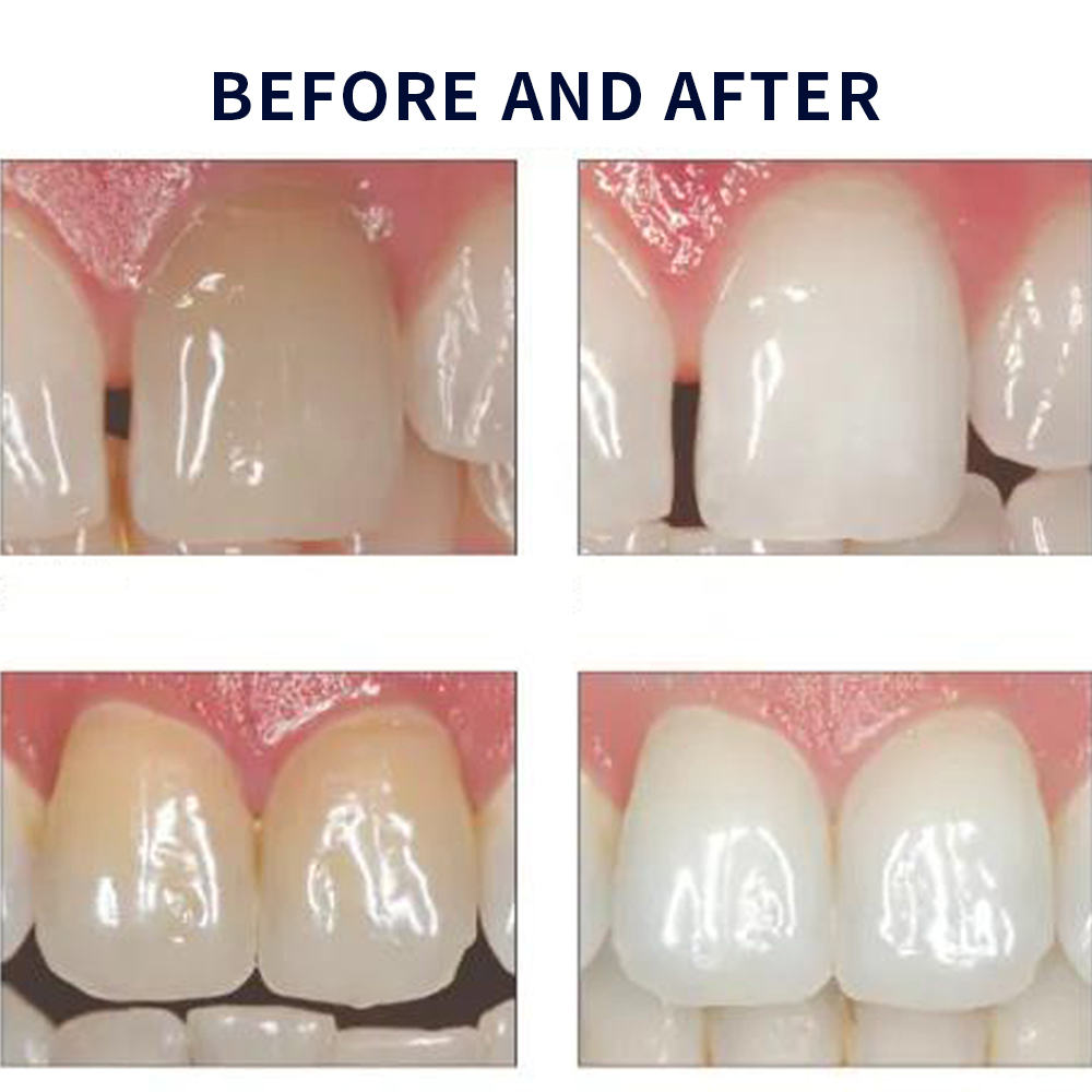 유백광 미백 20% PF 20 16 젤 키트, 초강력  - Teeth Whitening Gel Peroxide 리뷰 및 가격