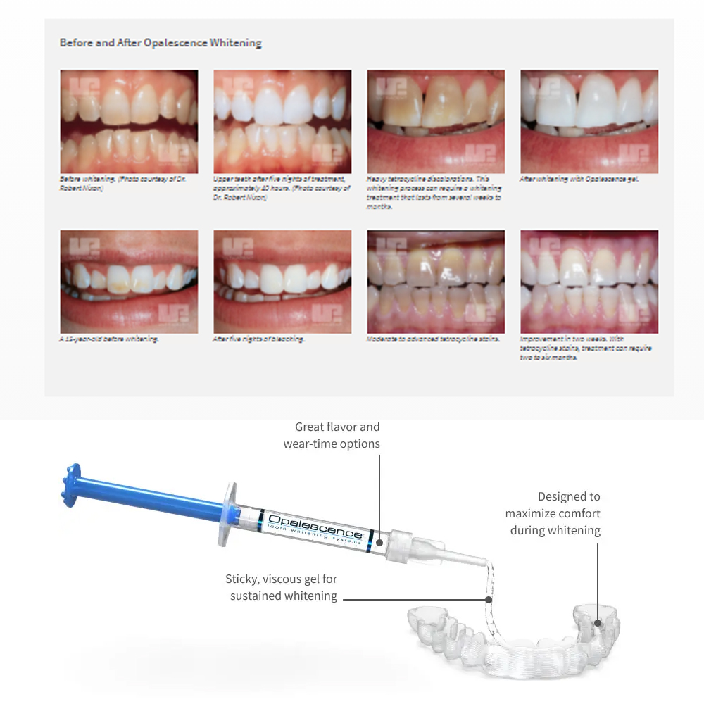 유백광 미백 20% PF 20 16 젤 키트, 초강력  - Teeth Whitening Gel Peroxide 리뷰 및 가격
