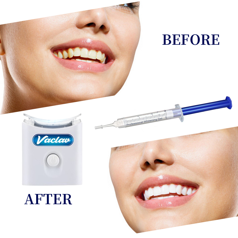민트 치아 미백 젤 주사기 가정용 치아 미백 키트 LE - Teeth Whitening Opalescence 리뷰 및 가격