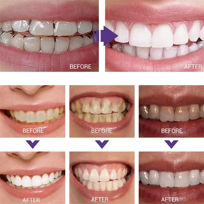 치아 세정 미백 치약 화이트닝 젤 미백제 얼룩 제거 상 - Teeth Whitening Korea 리뷰 및 가격