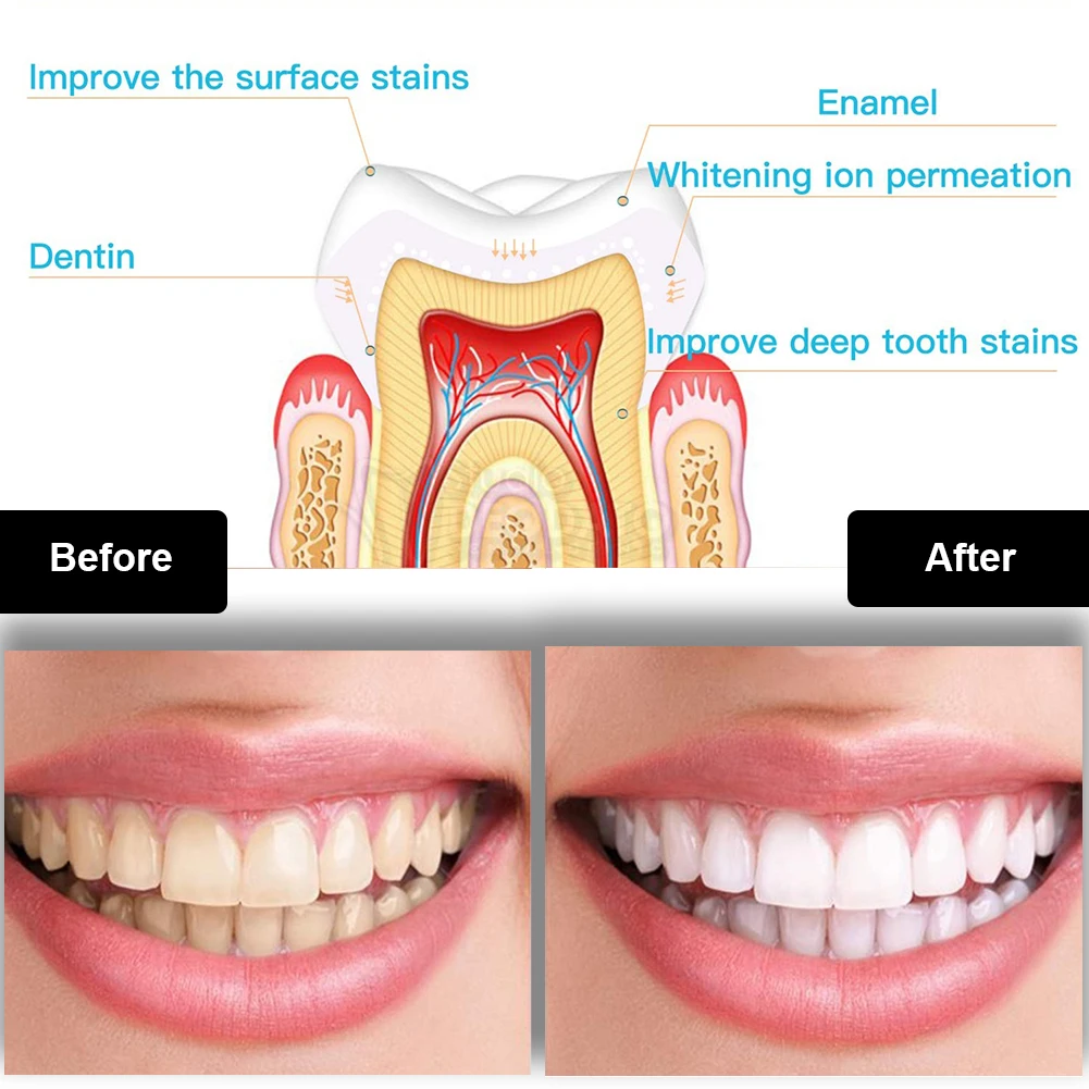 치과 치아 미백 키트 미니 16 LED 콜드 라이트 3 - Teeth Whitening Gel Peroxide 리뷰 및 가격
