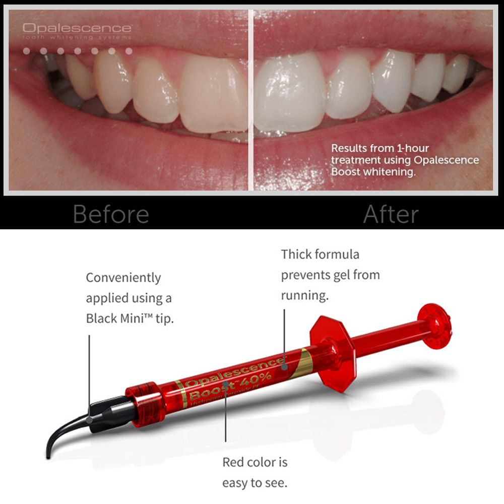울트라덴트 오팔레센스 부스트 PF 40% 치과용 미백  - Teeth Whitening Opalescence 리뷰 및 가격